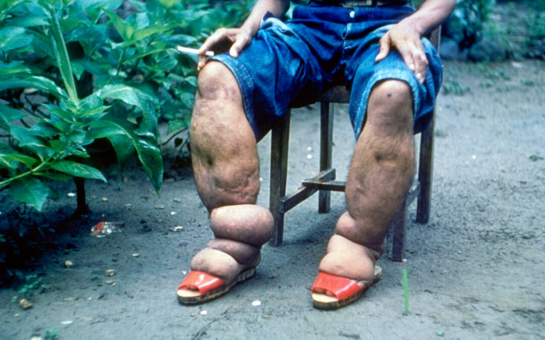 Lymphatic Filariasis caused by Parasitic Worms