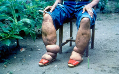 Lymphatic Filariasis caused by Parasitic Worms